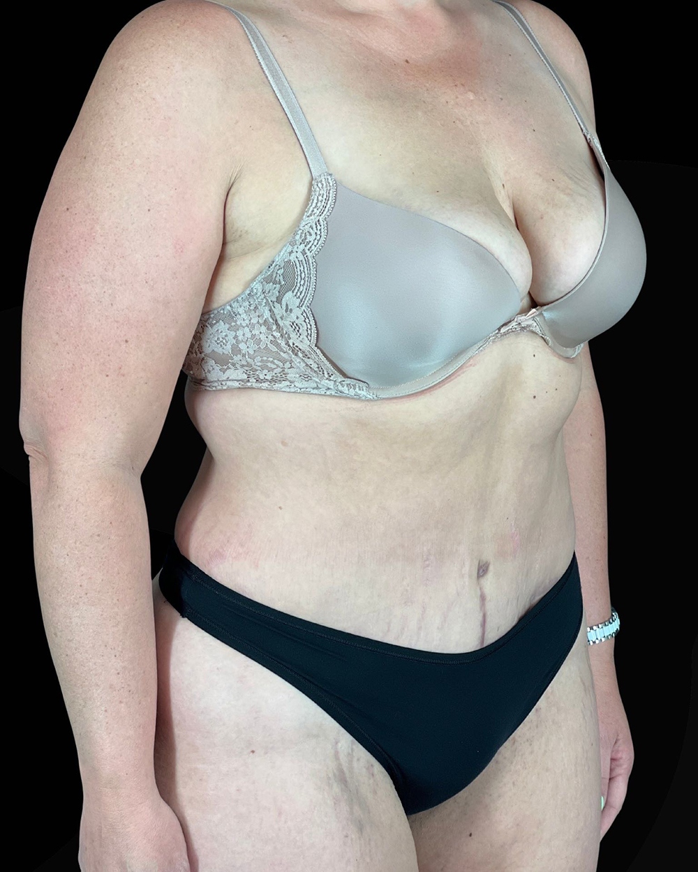 Case--9283 | After Abdominoplasty 2