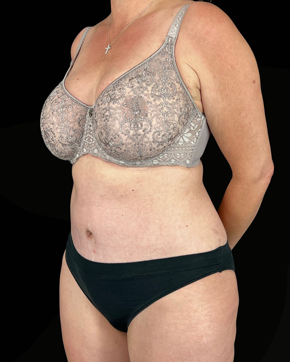 Case--7074 | After Abdominoplasty 2