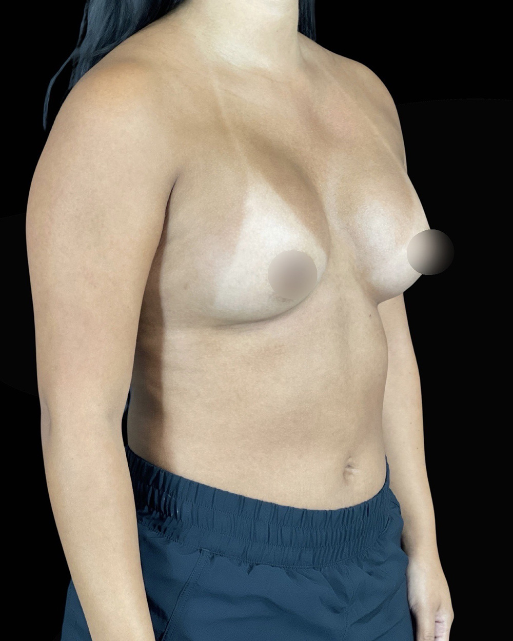 Case--8015 | After Breast Augmentation 2