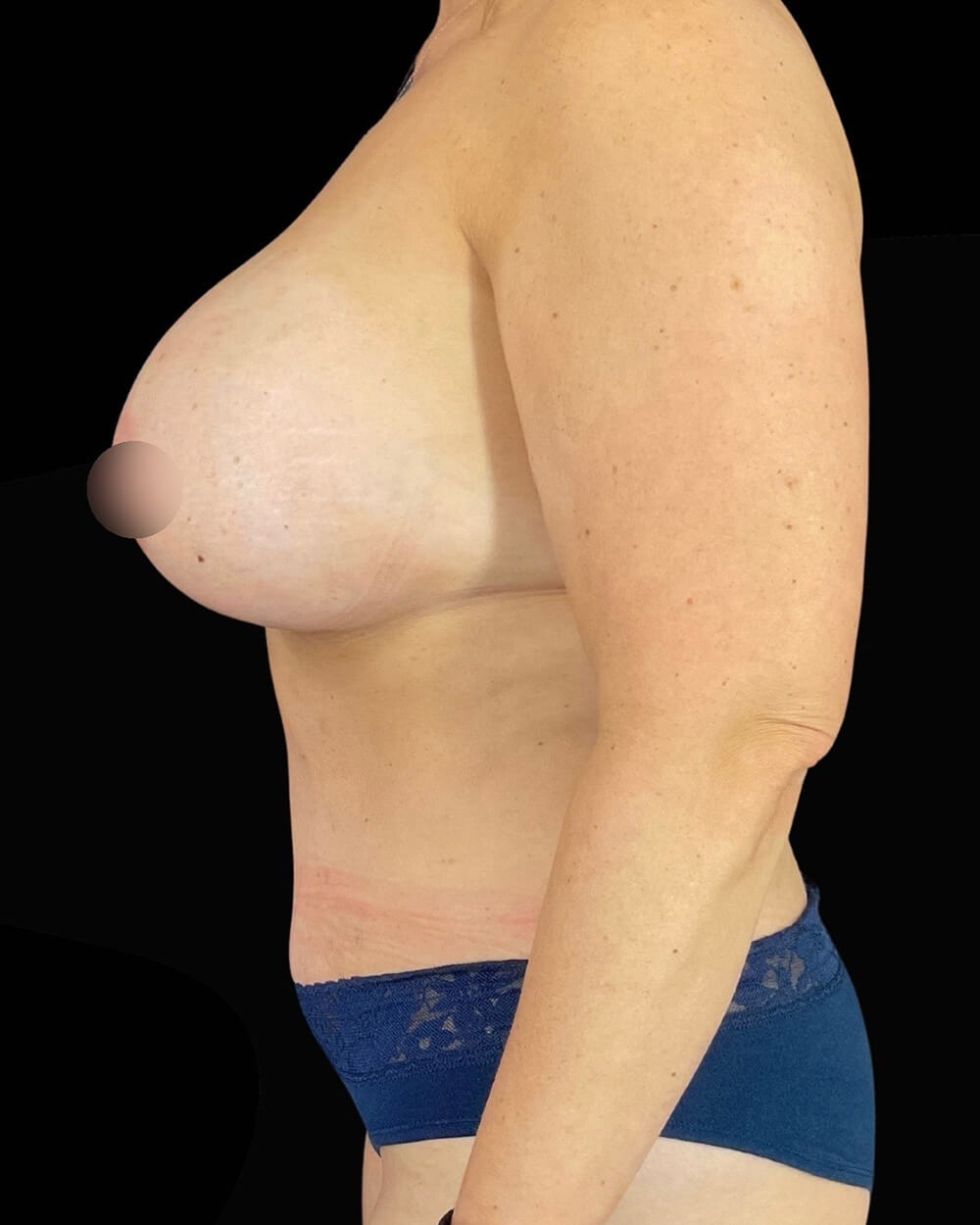 Case--8427 | After Mommy Makeover 3