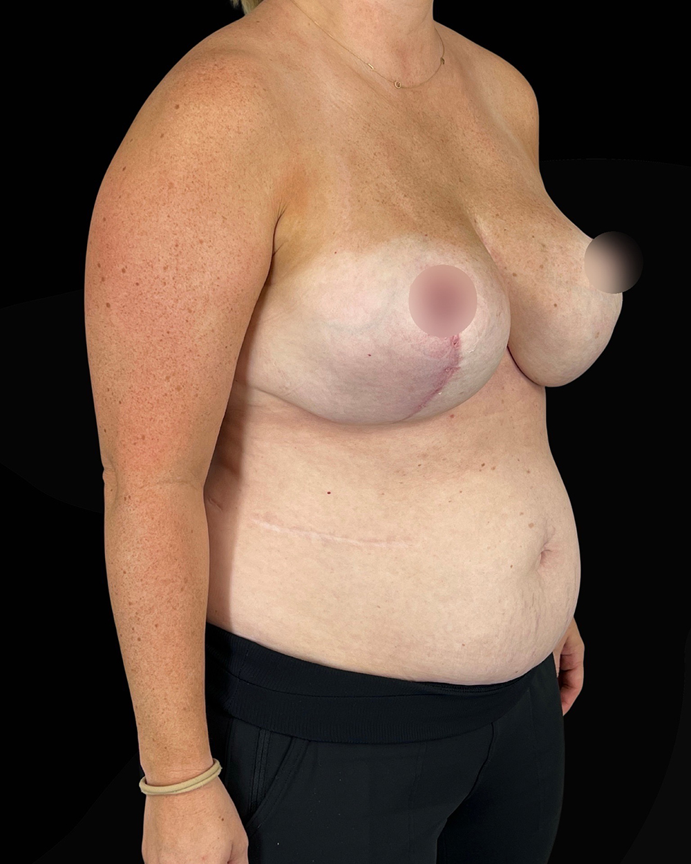 Case--5023 | After Breast Reduction/Lift 2