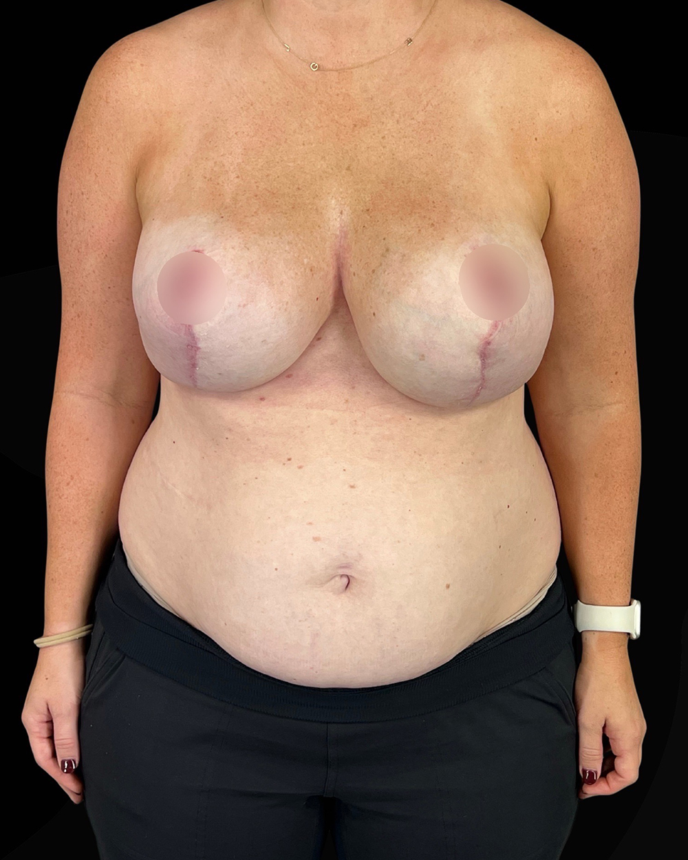 Case--5023 | After Breast Reduction/Lift