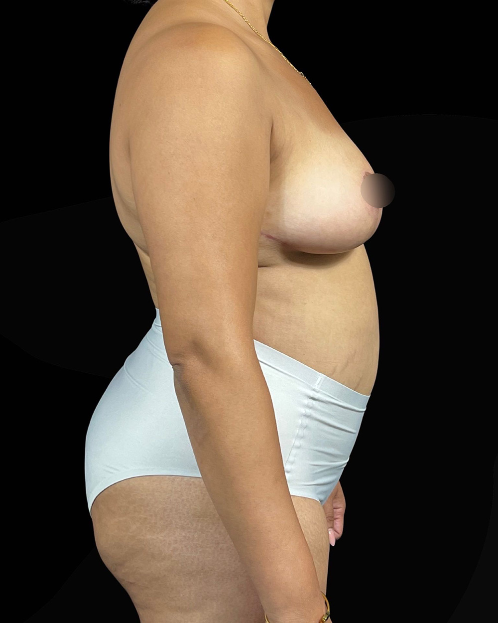 Case--9796 | After Mommy Makeover 2