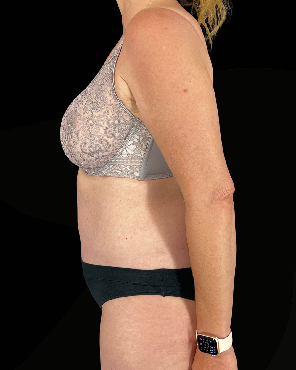 Case--7074 | After Abdominoplasty 3