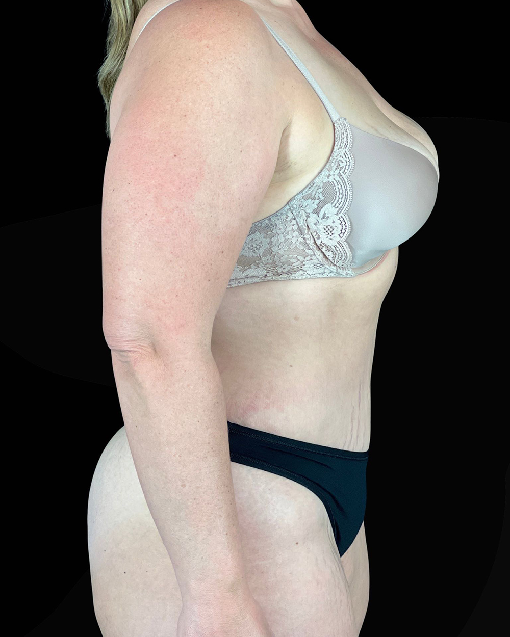 Case--9283 | After Abdominoplasty 3