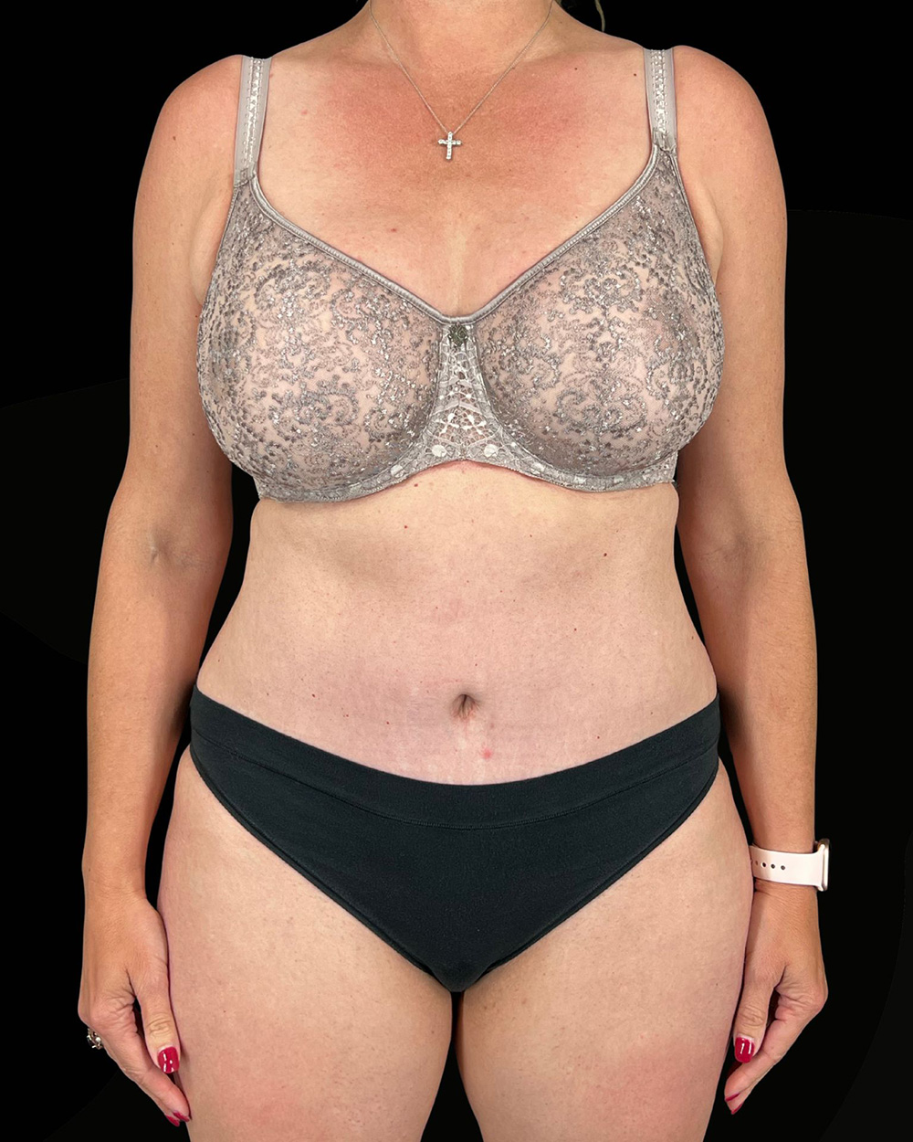 Case--7074 | After Abdominoplasty