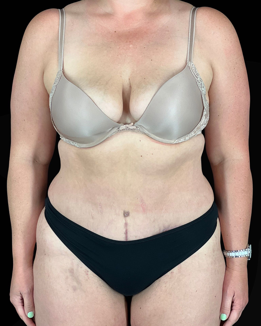 Case--9283 | After Abdominoplasty