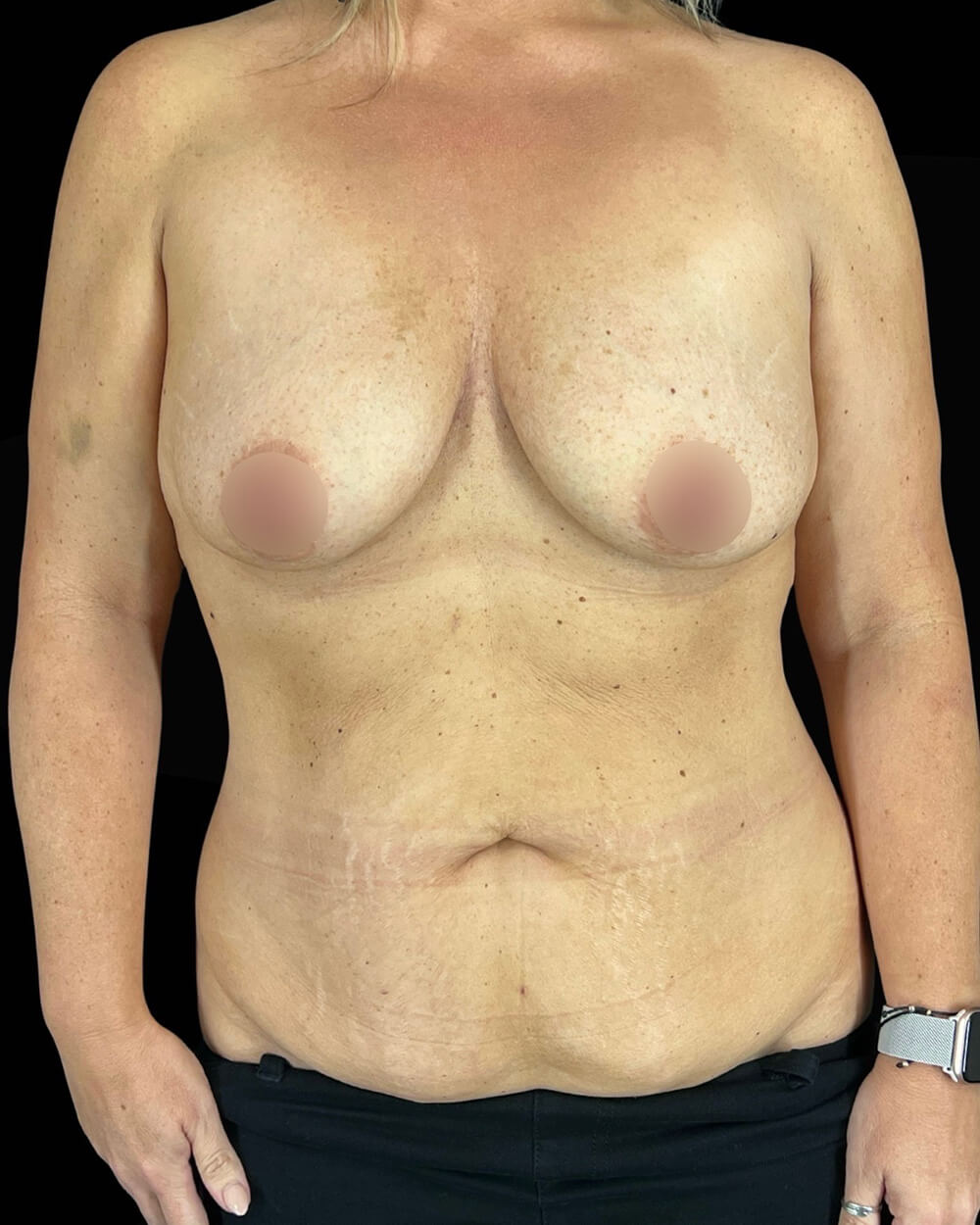 Case--8427 | Before Mommy Makeover