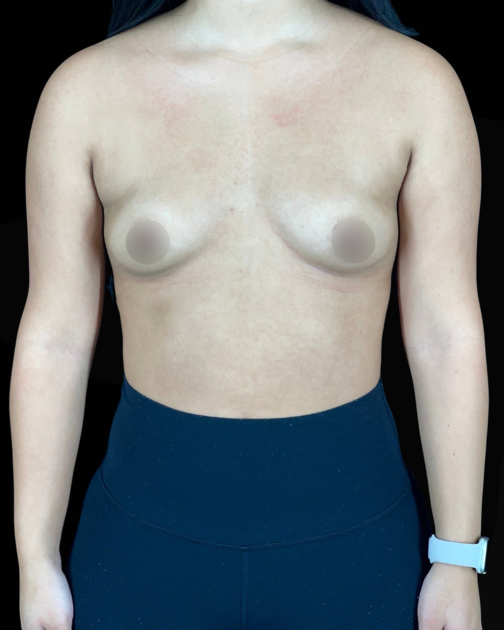 Case--8015 | Before Breast Augmentation