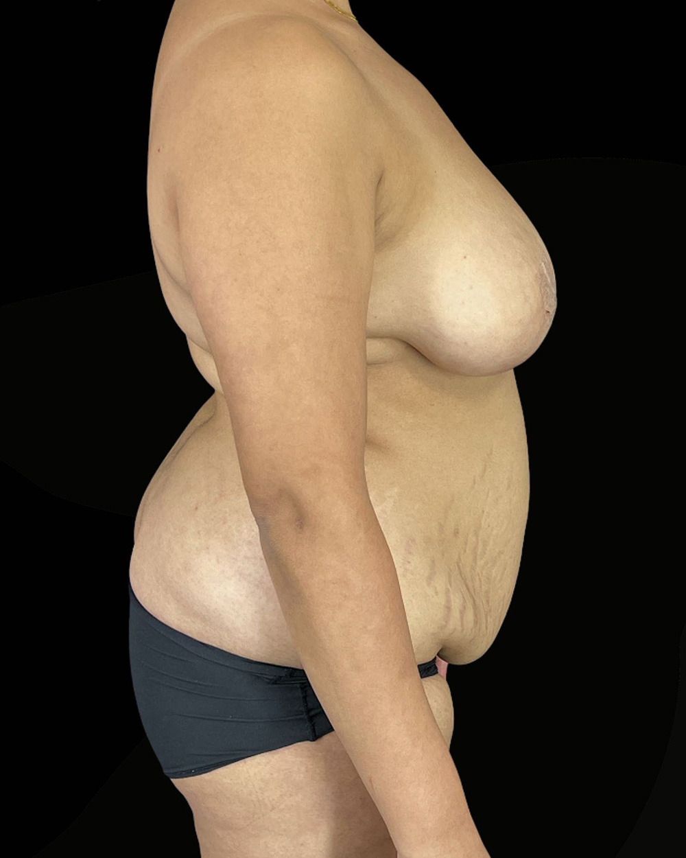 Case--9796 | Before Mommy Makeover 2