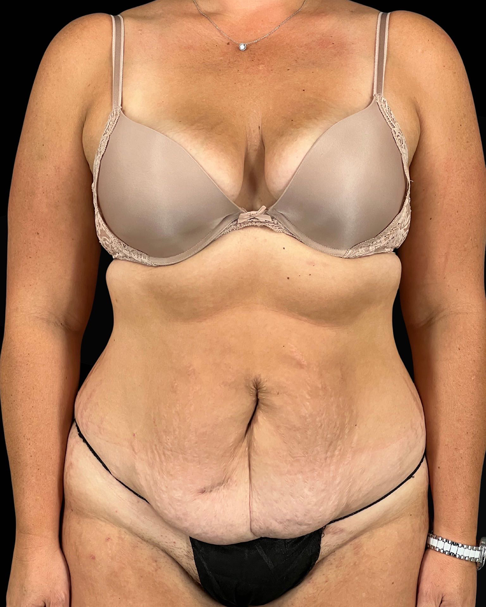 Case--9283 | Before Abdominoplasty