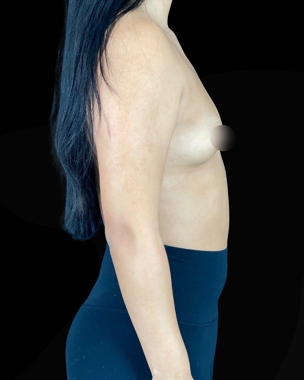 Case--8015 | Before Breast Augmentation 3