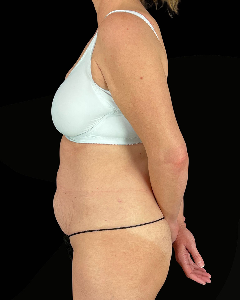 Case--7074 | Before Abdominoplasty 3