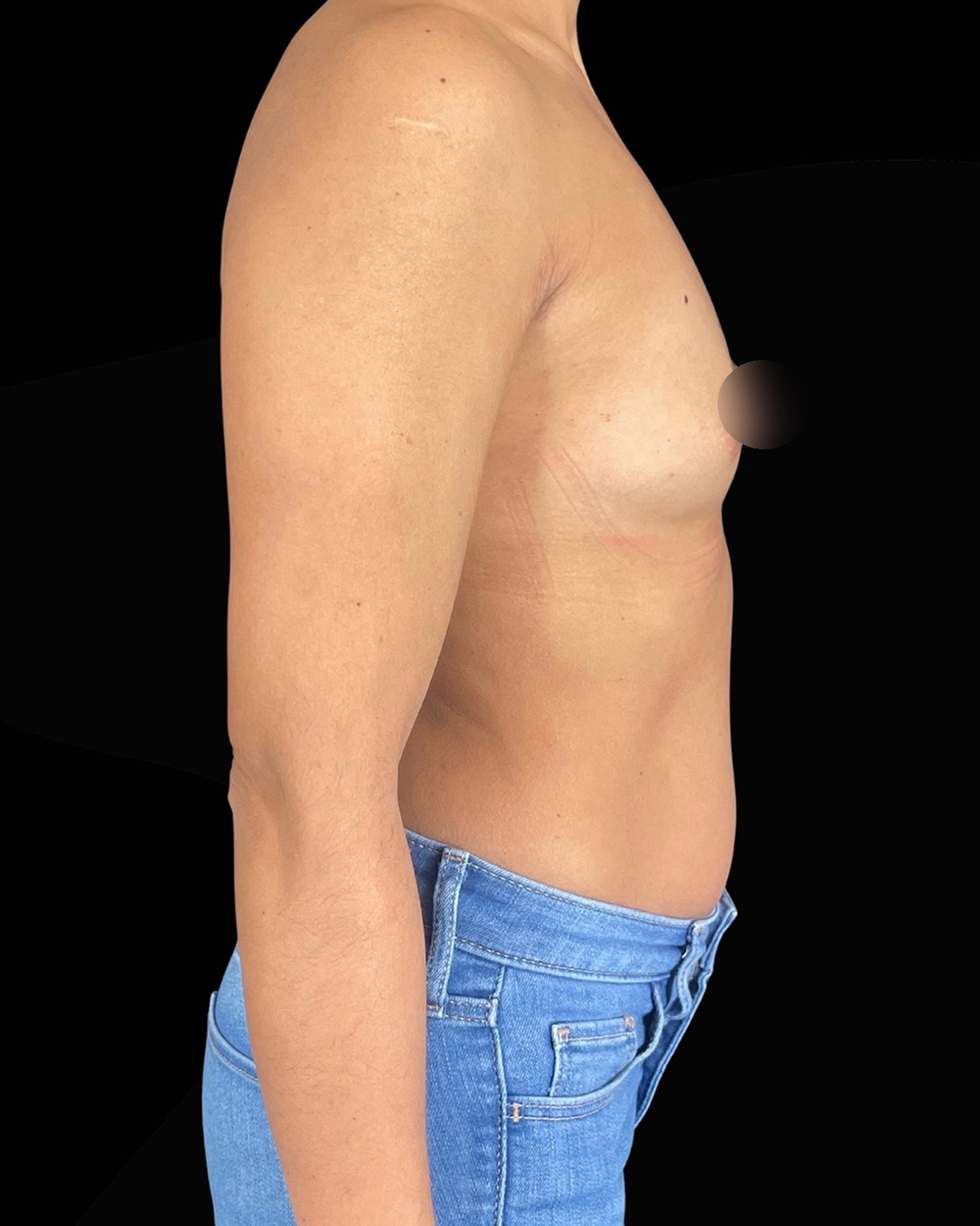 Case--6513 | Before Breast Augmentation 3