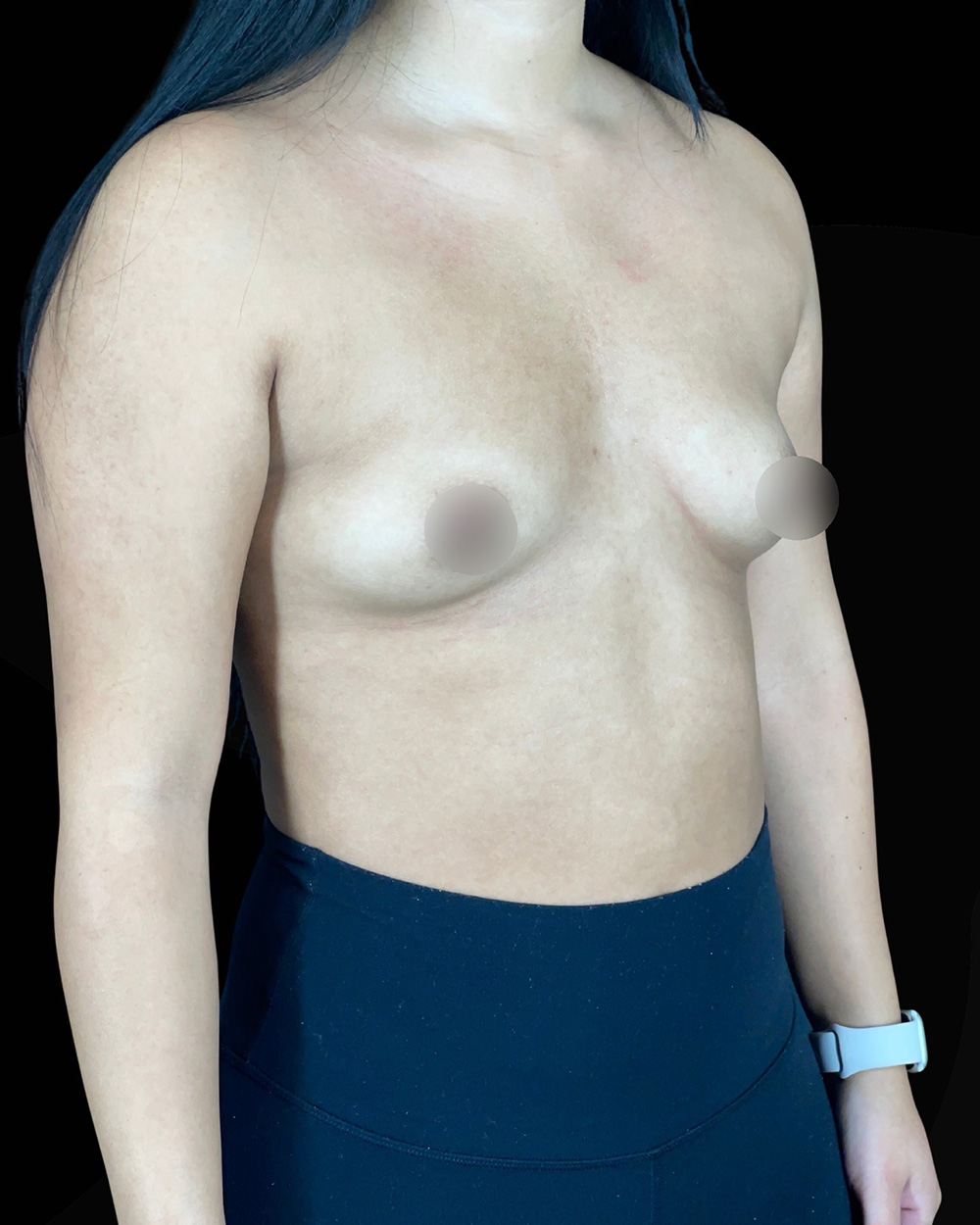 Case--8015 | Before Breast Augmentation 2