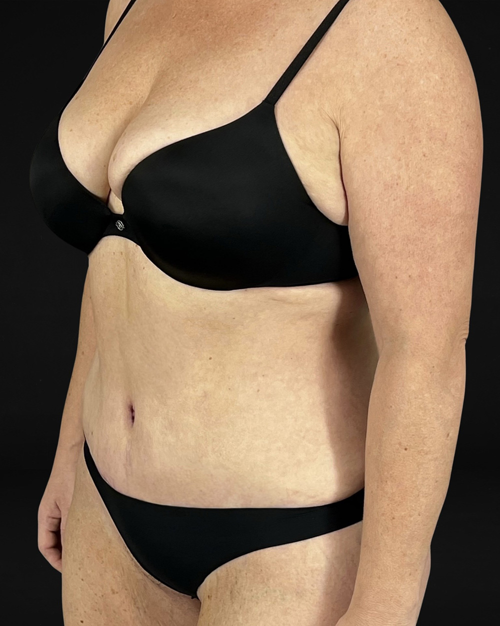 Case--6580 | After Abdominoplasty 3