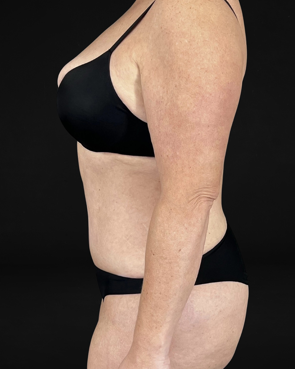 Case--6580 | After Abdominoplasty 4