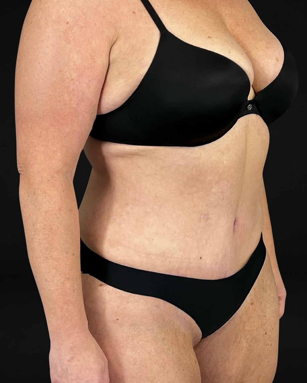 Case--6580 | After Abdominoplasty 2