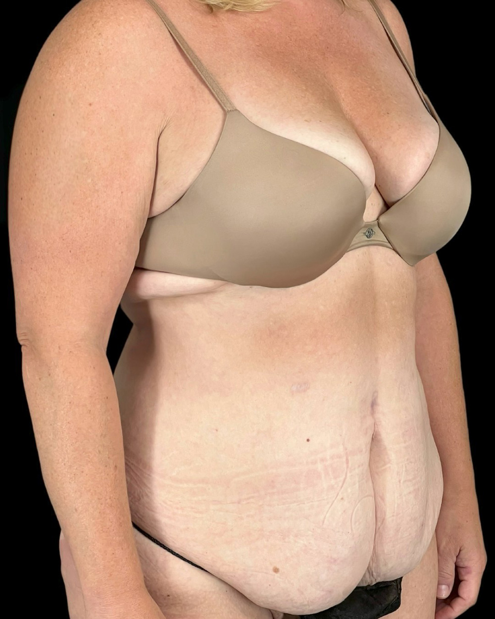 Case--6580 | Before Abdominoplasty 2