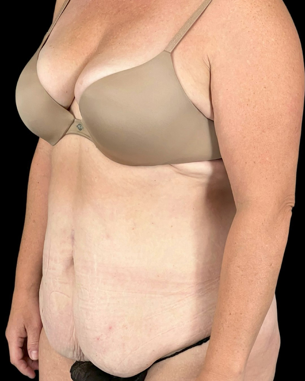 Case--6580 | Before Abdominoplasty 3