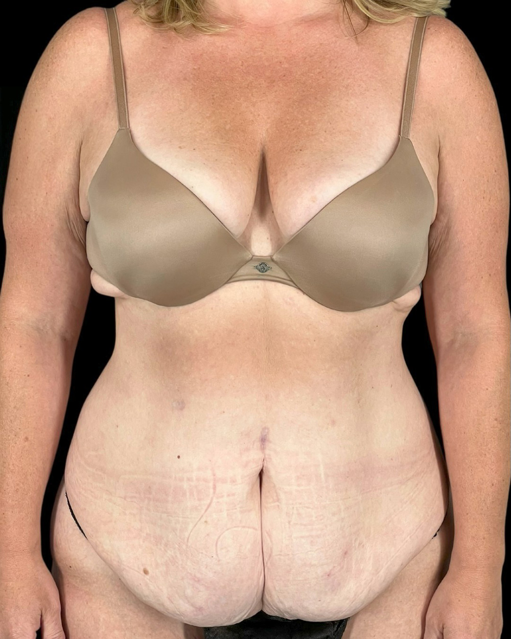 Case--6580 | Before Abdominoplasty