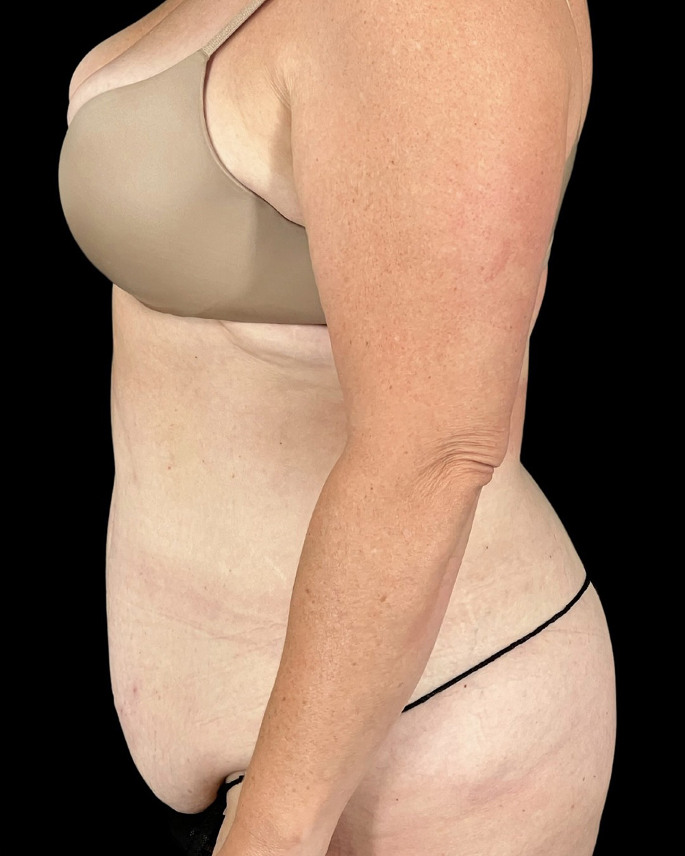 Case--6580 | Before Abdominoplasty 4