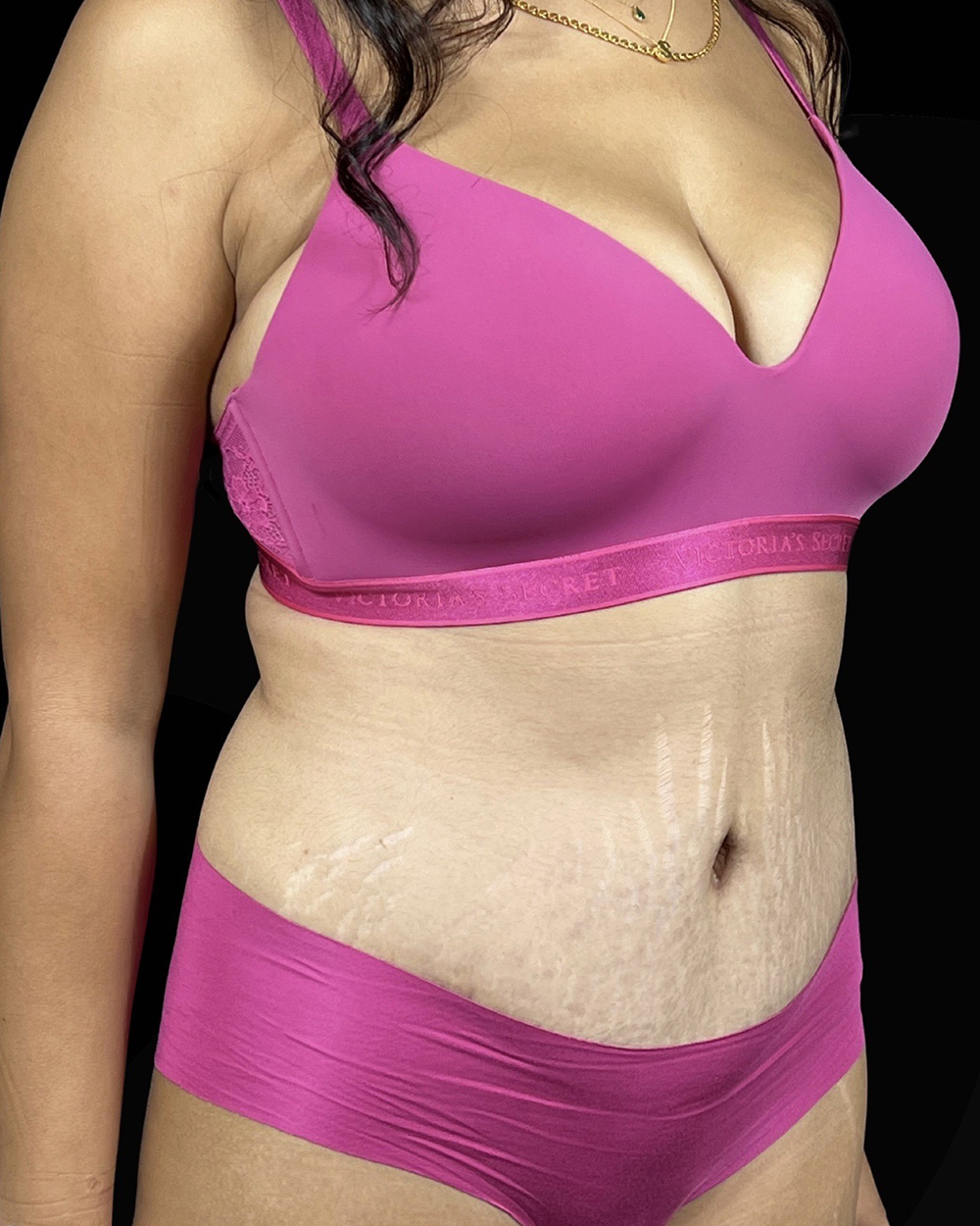 Case--5405 | After Abdominoplasty 2