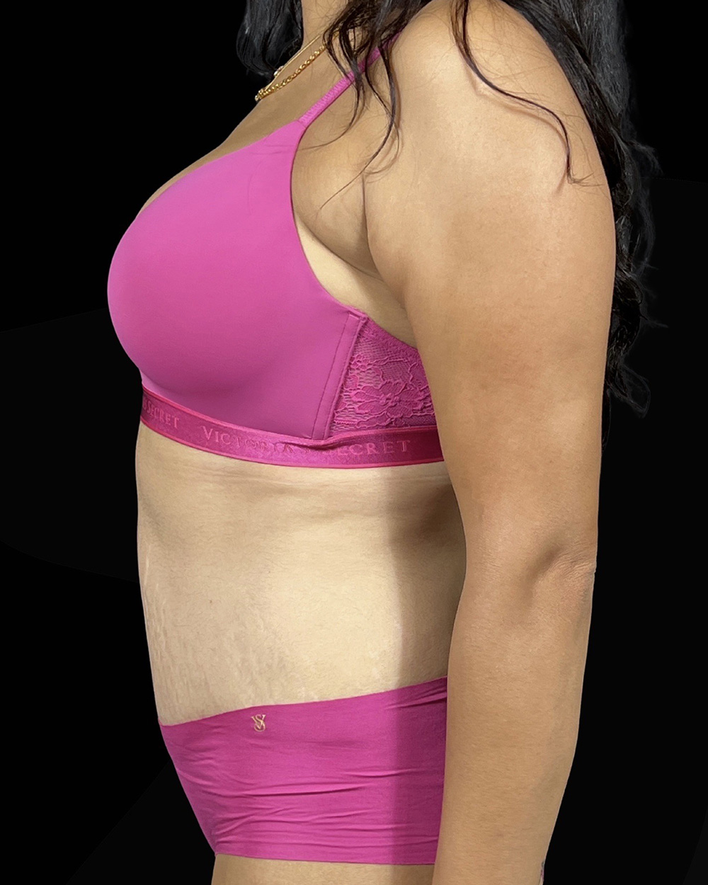 Case--5405 | After Abdominoplasty 3