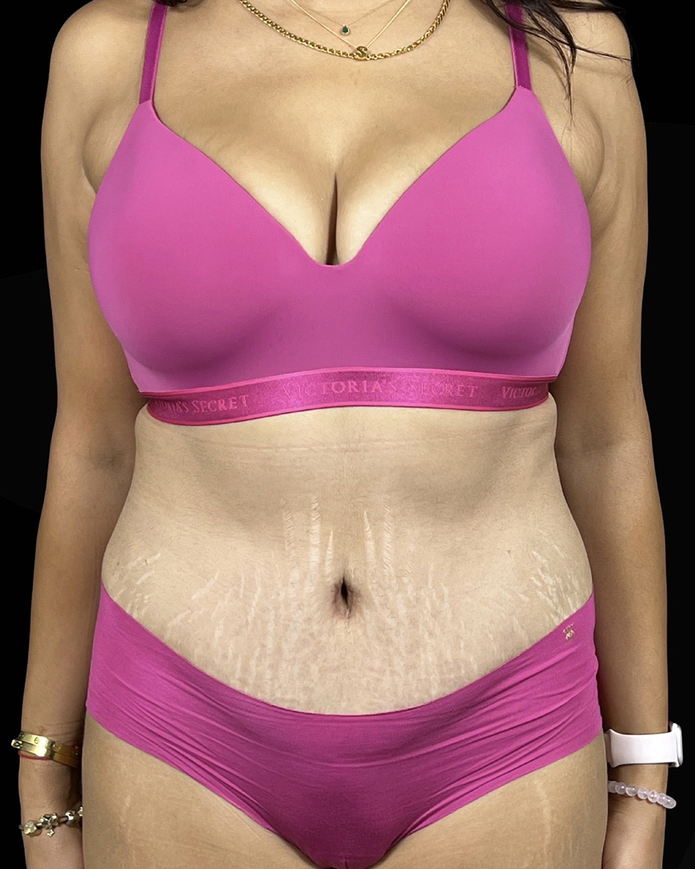 Case--5405 | After Abdominoplasty