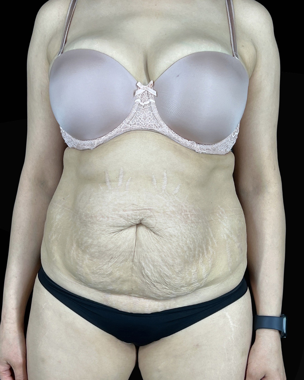 Case--5405 | Before Abdominoplasty