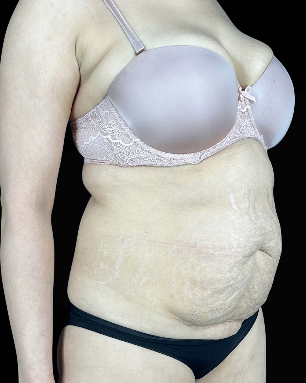 Case--5405 | Before Abdominoplasty 2