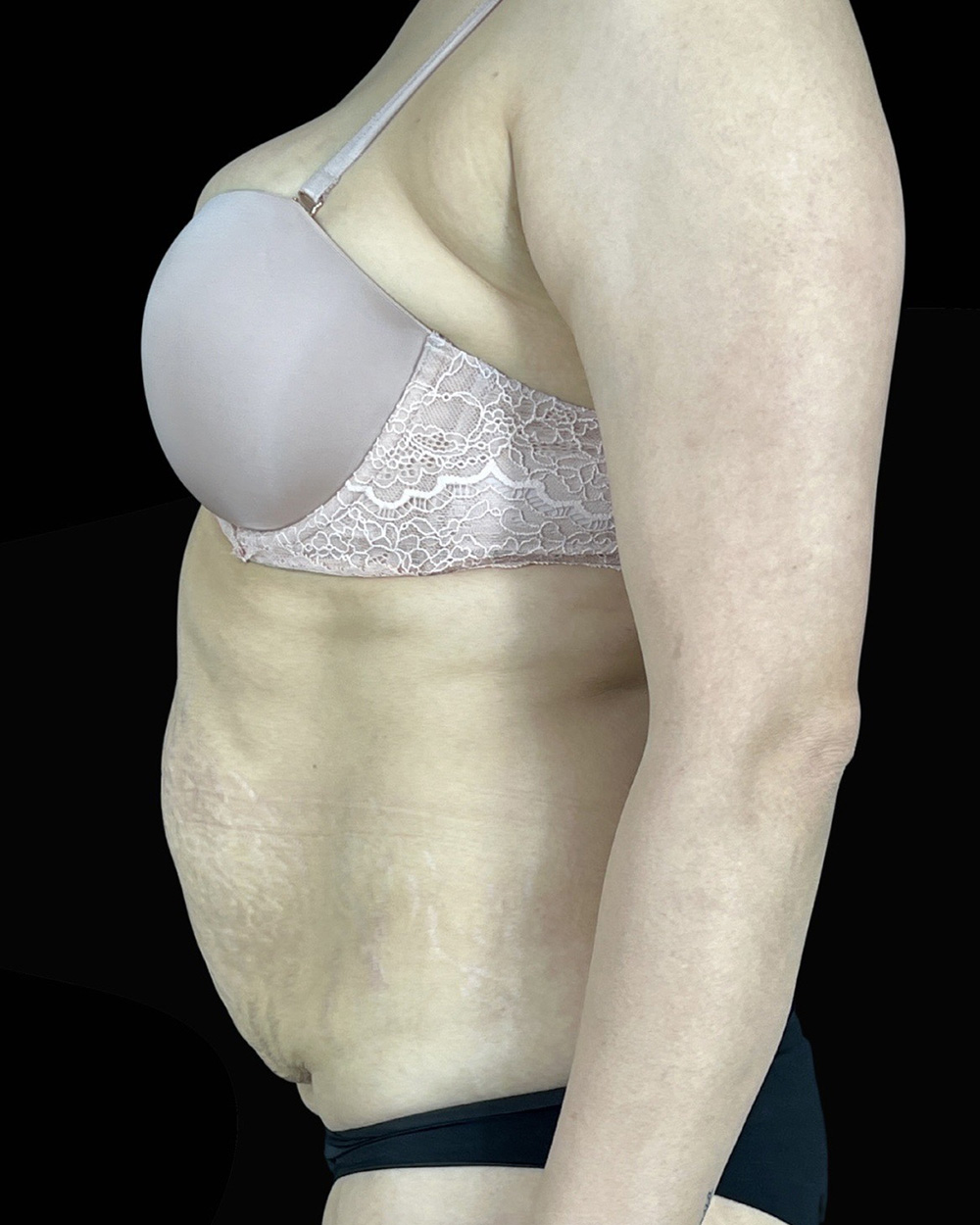 Case--5405 | Before Abdominoplasty 3