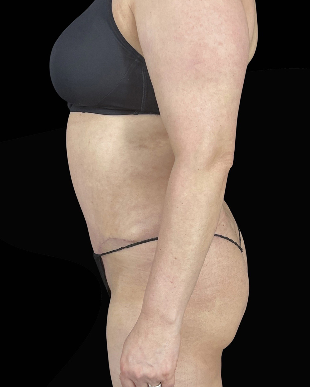 Case--7386 | After Abdominoplasty