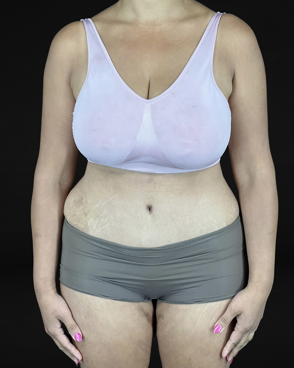 Case--9287 | After Abdominoplasty