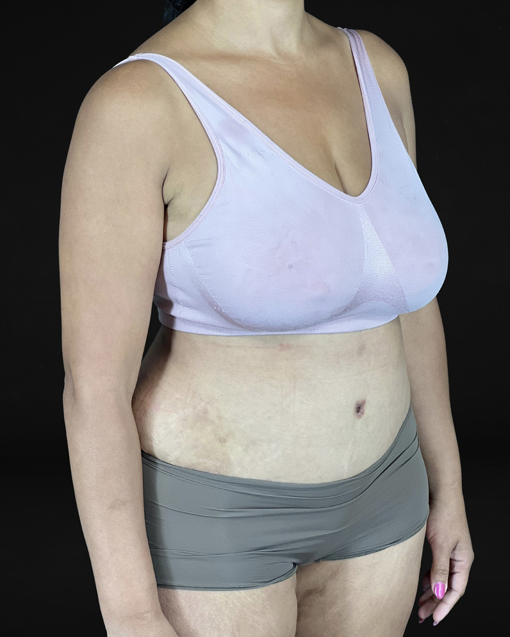 Case--9287 | After Abdominoplasty 2
