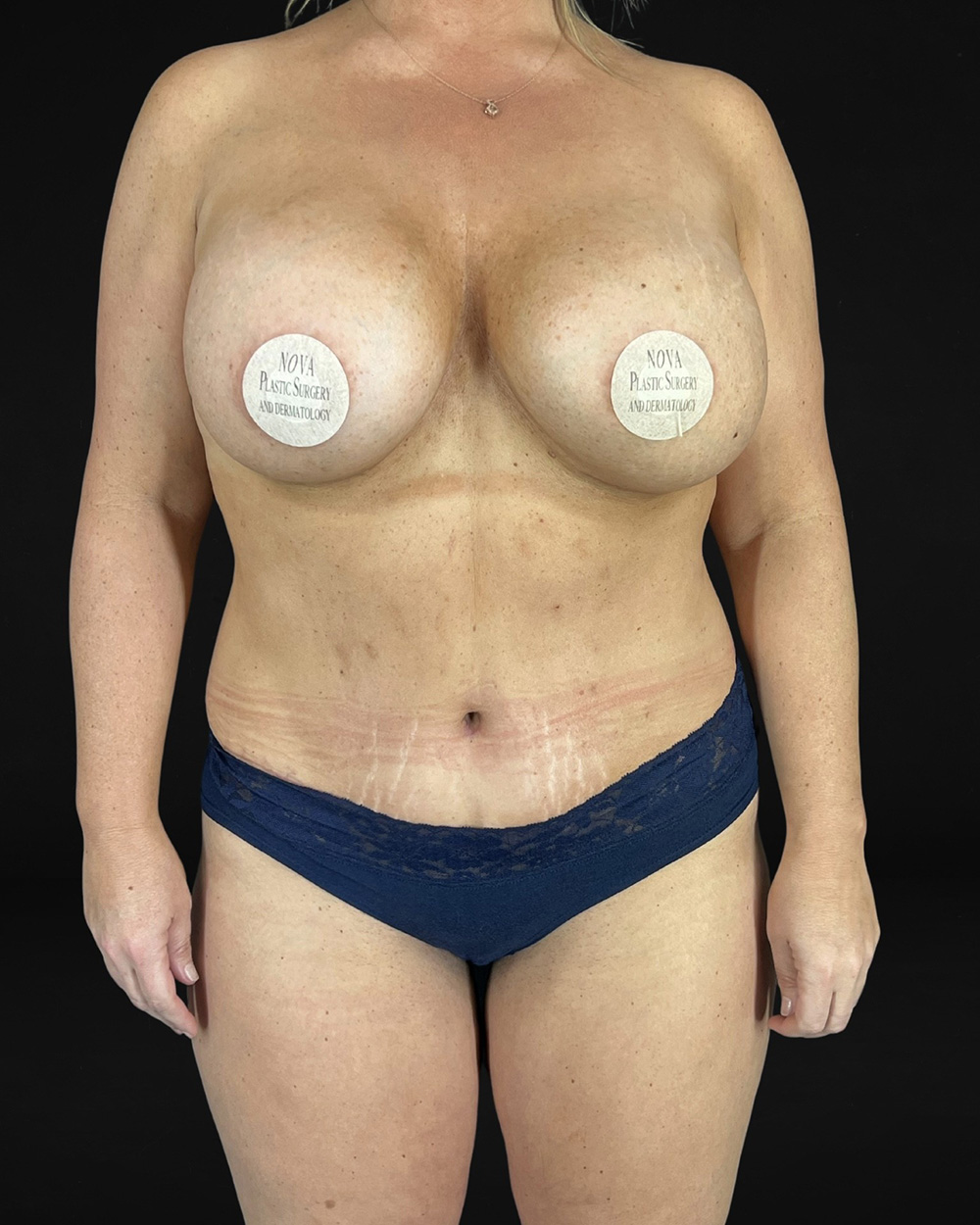 Case--5234 | After Abdominoplasty