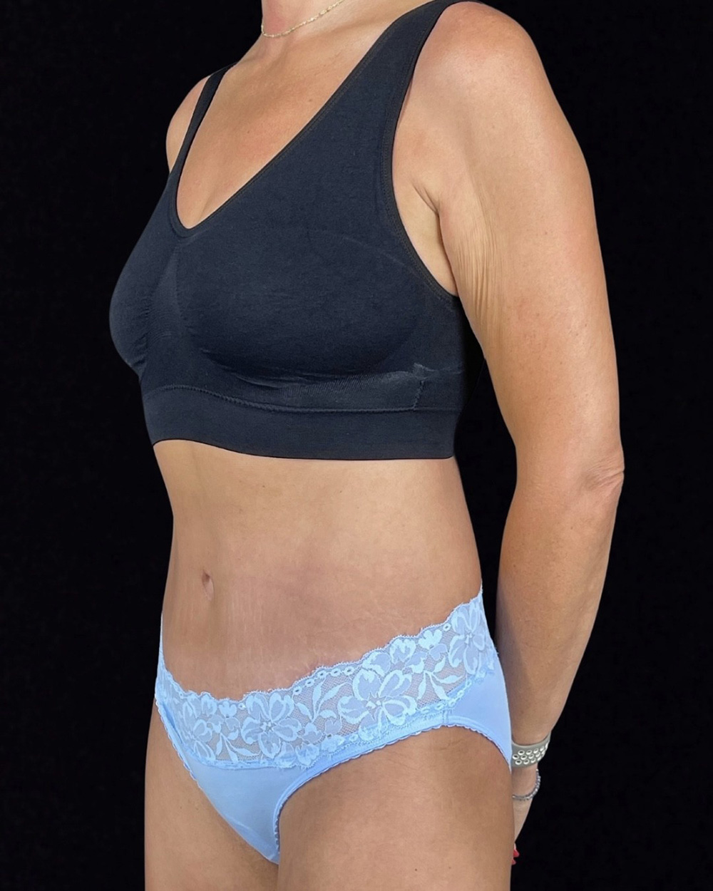 Case--4857 | After Abdominoplasty