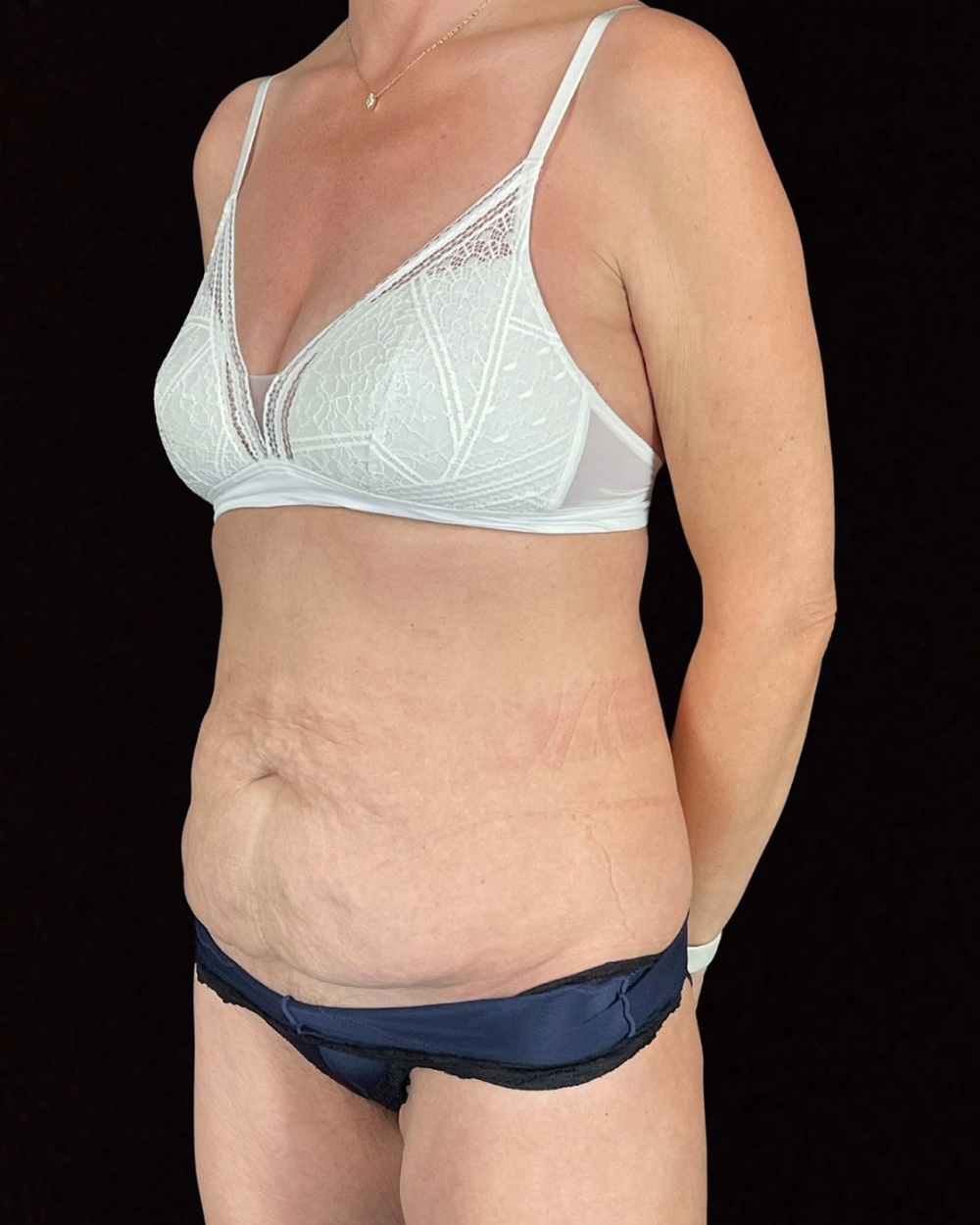 Case--4857 | Before Abdominoplasty
