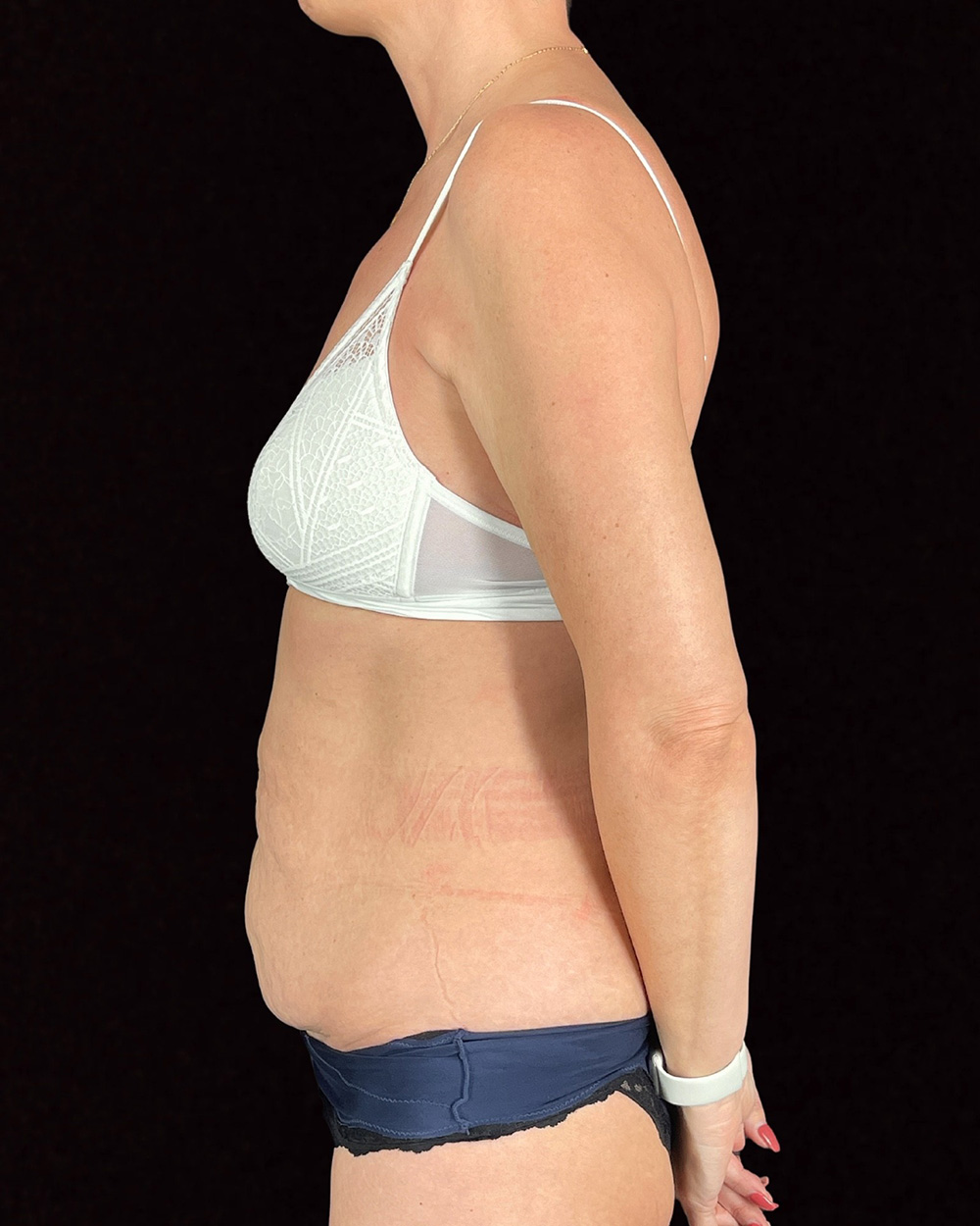 Case--4857 | Before Abdominoplasty 2