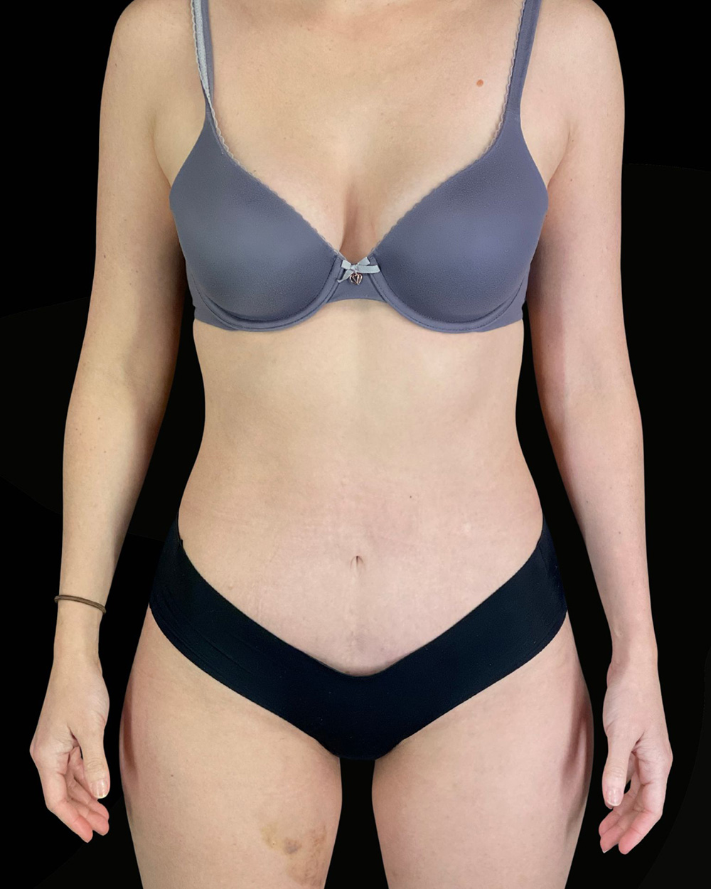 Case--7760 | After Abdominoplasty