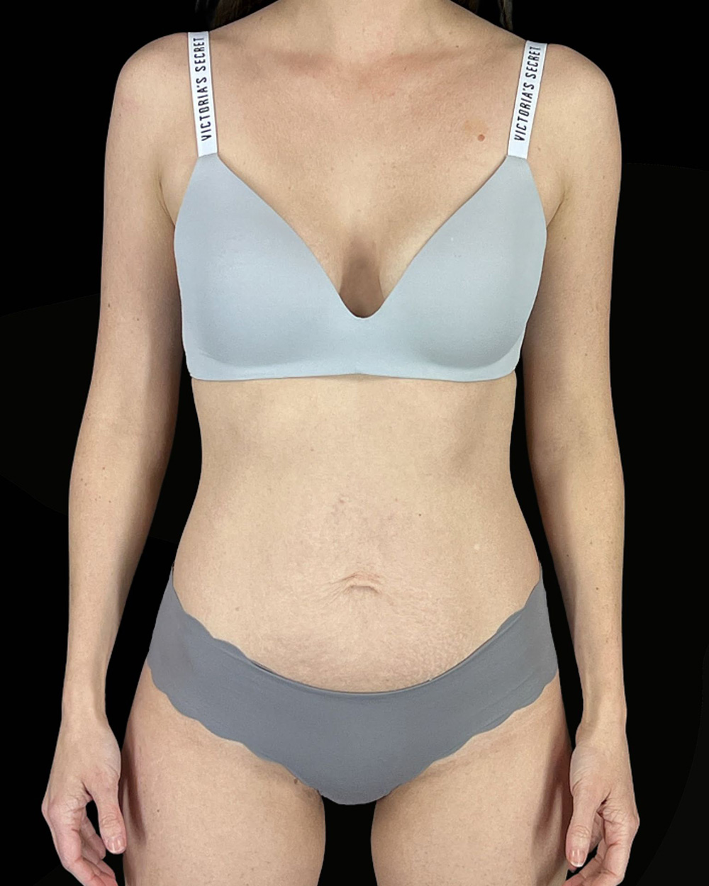 Case--7760 | Before Abdominoplasty