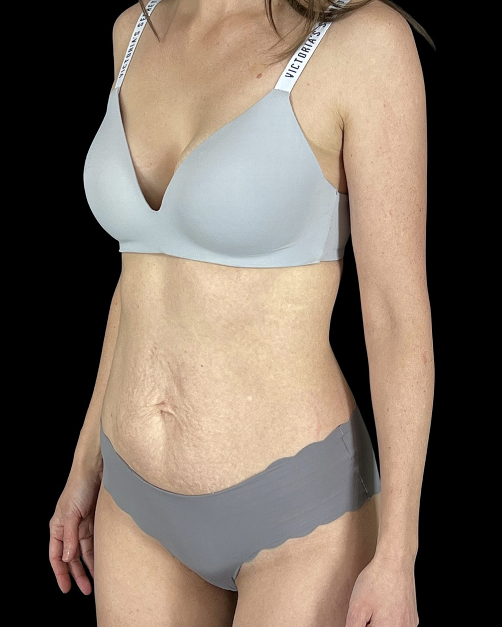 Case--7760 | Before Abdominoplasty 3