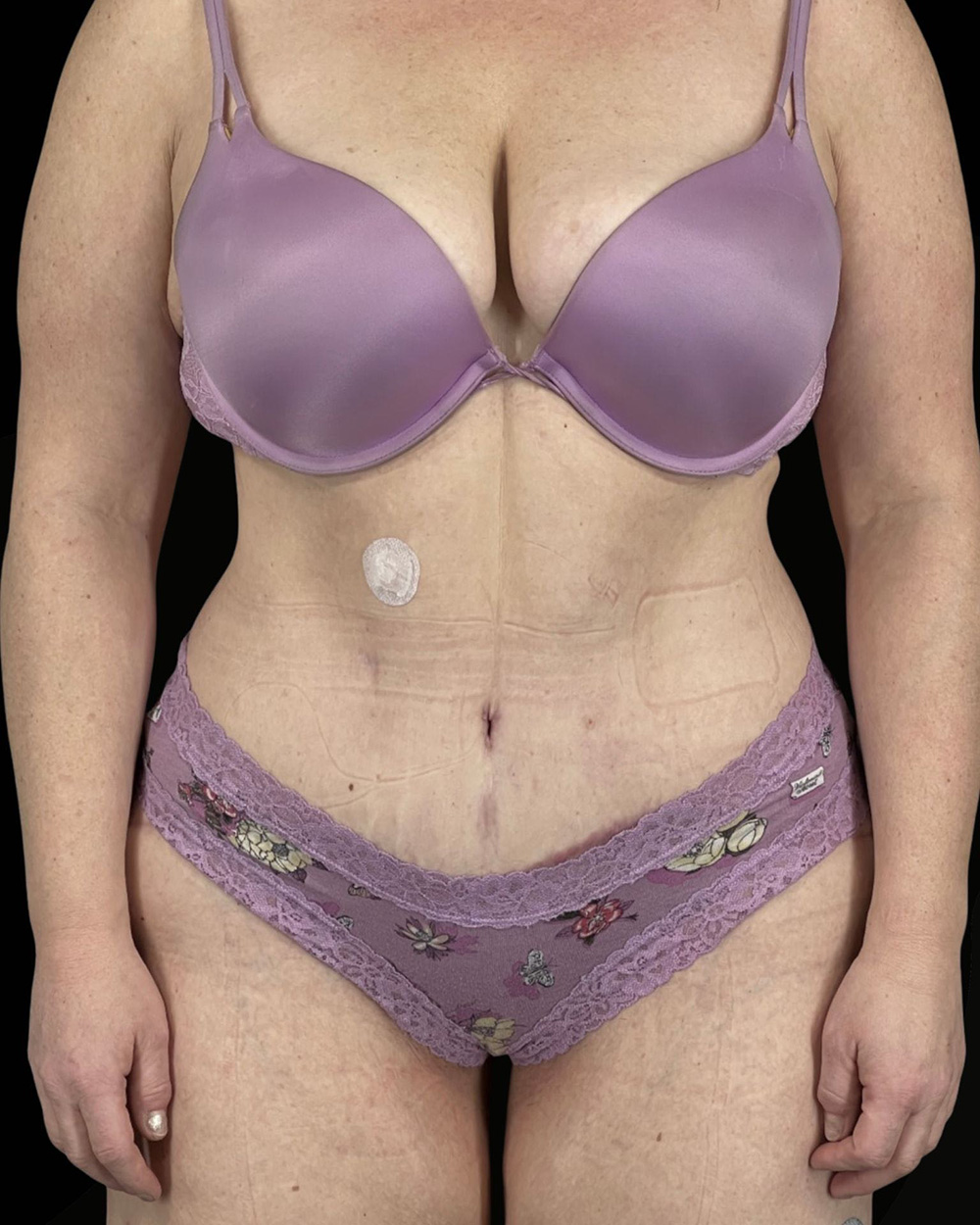 Case--4470 | After Abdominoplasty