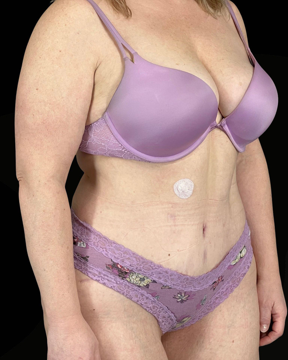 Case--4470 | After Abdominoplasty 2