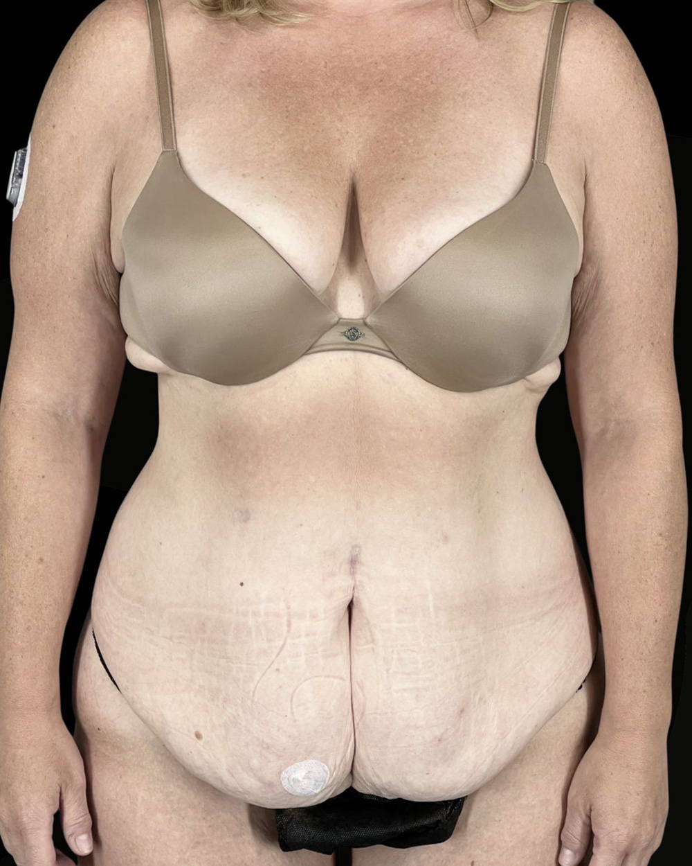 Case--4470 | Before Abdominoplasty
