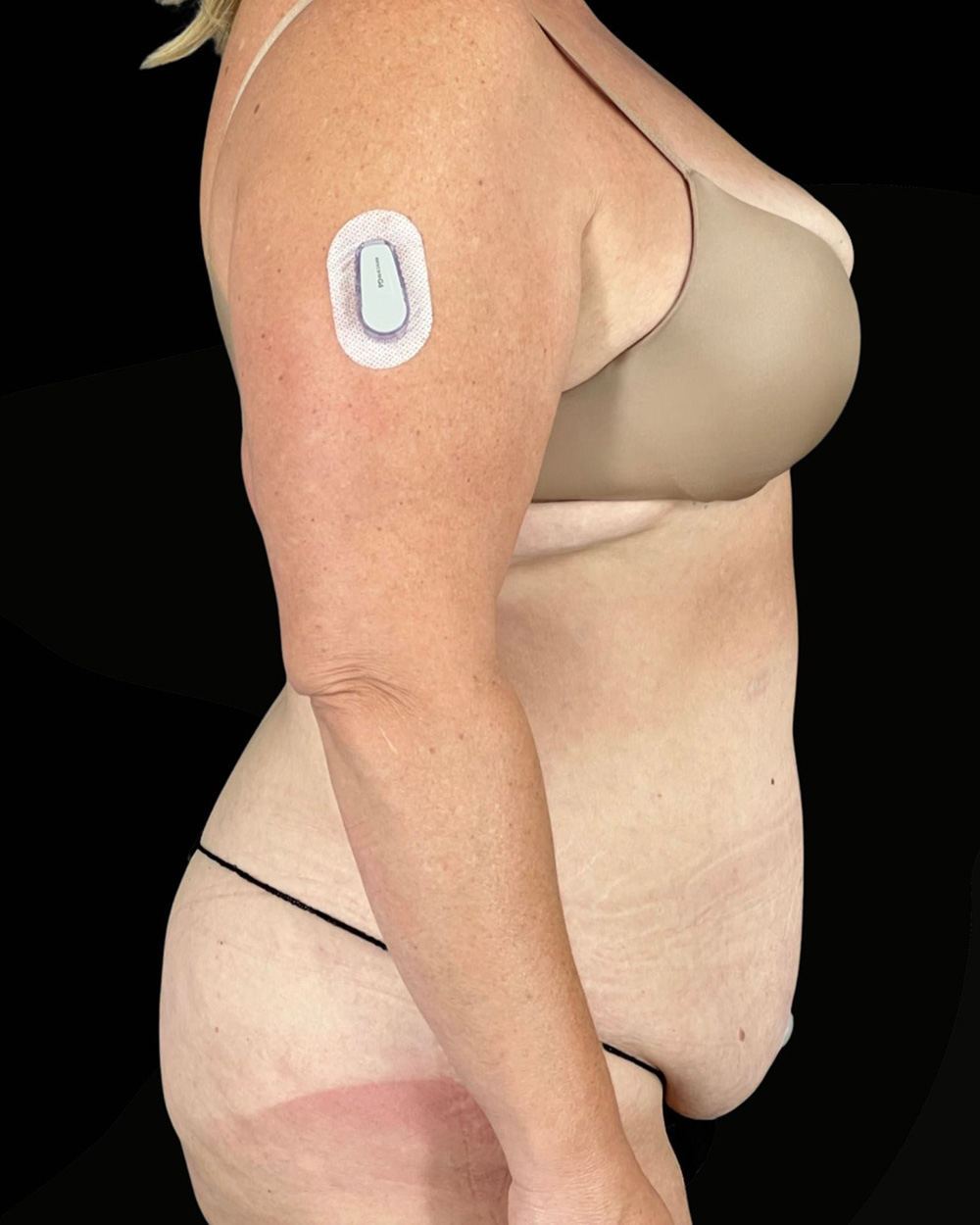 Case--4470 | Before Abdominoplasty 3