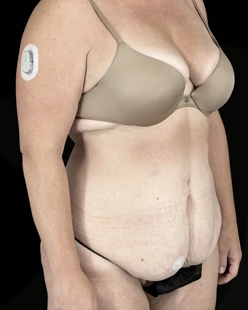 Case--4470 | Before Abdominoplasty 2