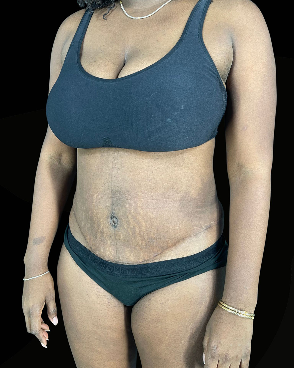 Case--6142 | After Abdominoplasty 2