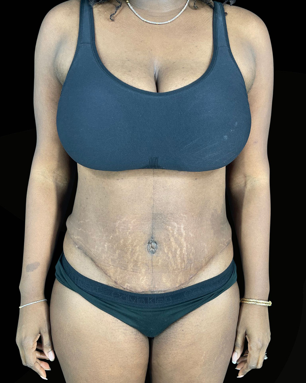 Case--6142 | After Abdominoplasty
