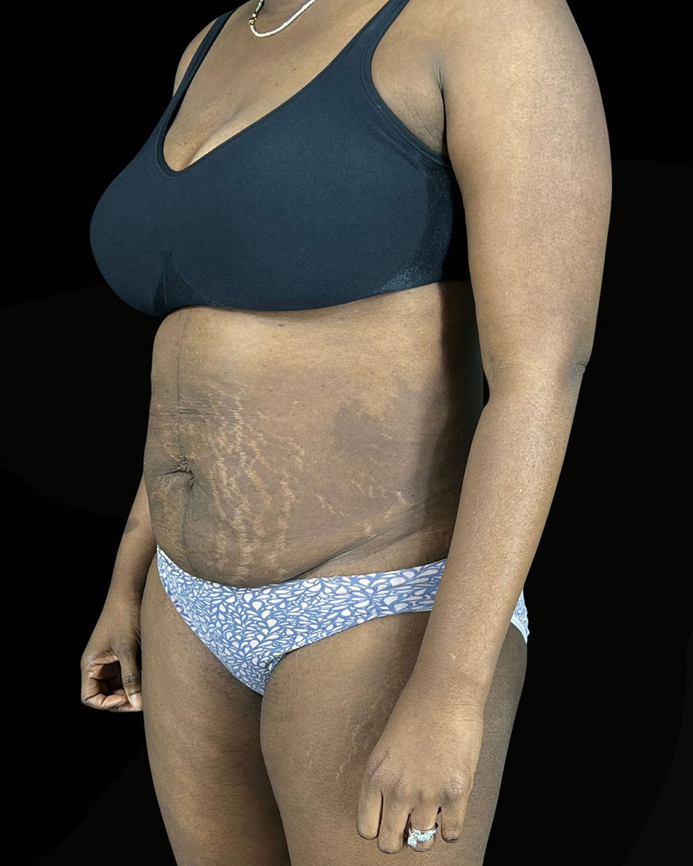 Case--6142 | Before Abdominoplasty 2